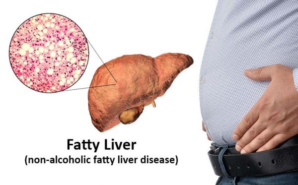 Fatty Liver लो इन उपायों से करे ठीक 